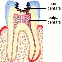 tratament-endo