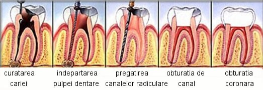 endodontie